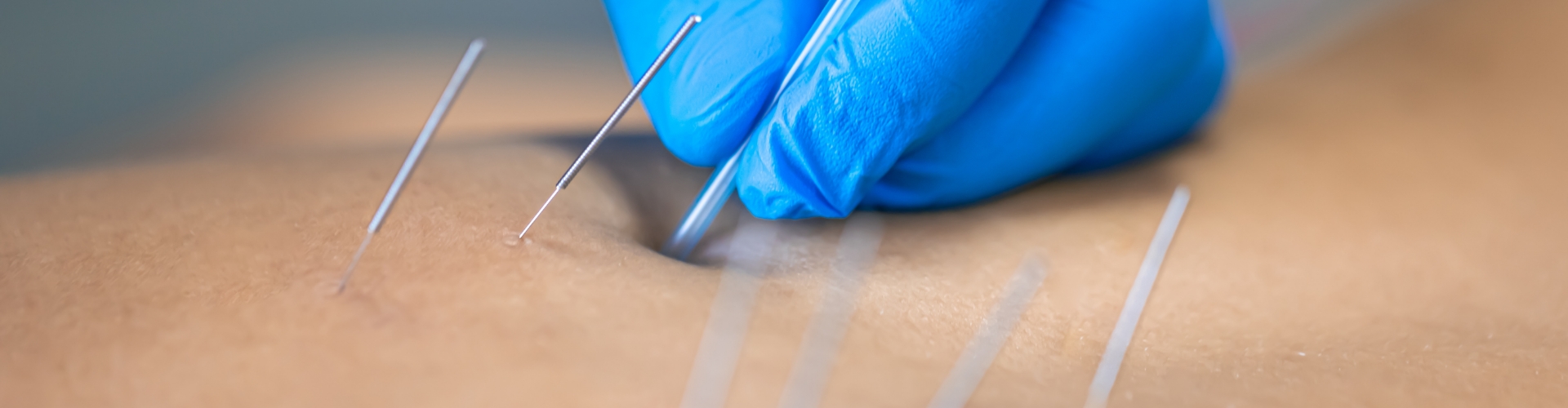 Dry Needling